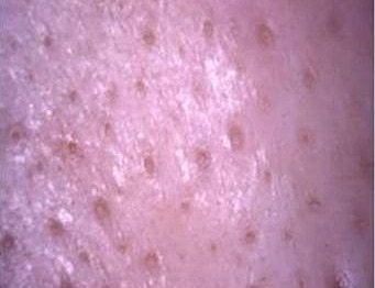 Close-up of textured skin surface.