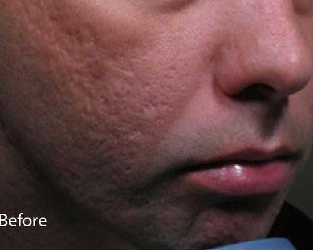 Close-up of man's face with skin texture concerns.