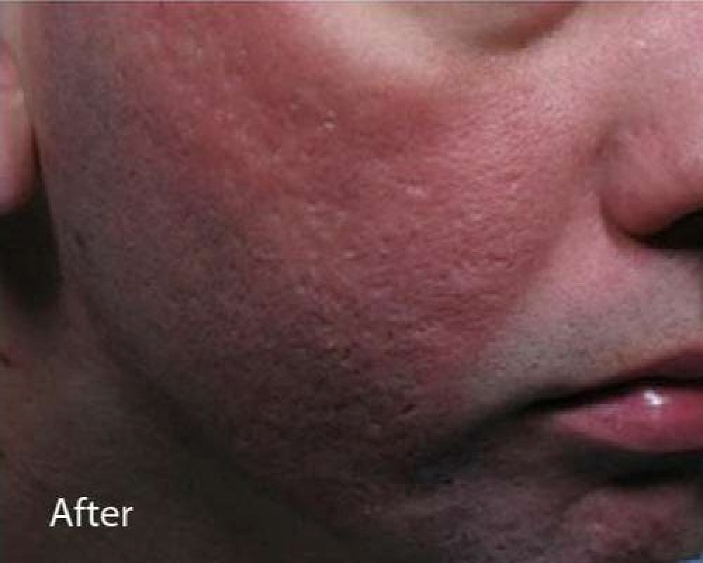 Skin texture after treatment close-up image.