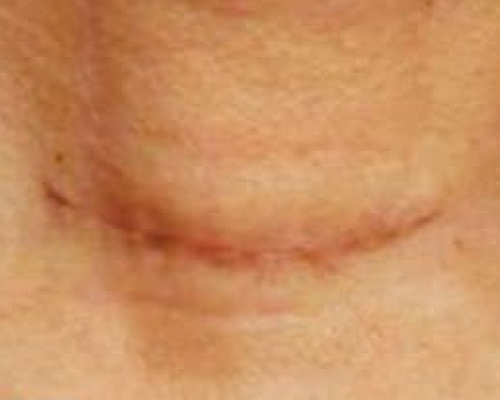 Close-up of skin with a surgical scar.