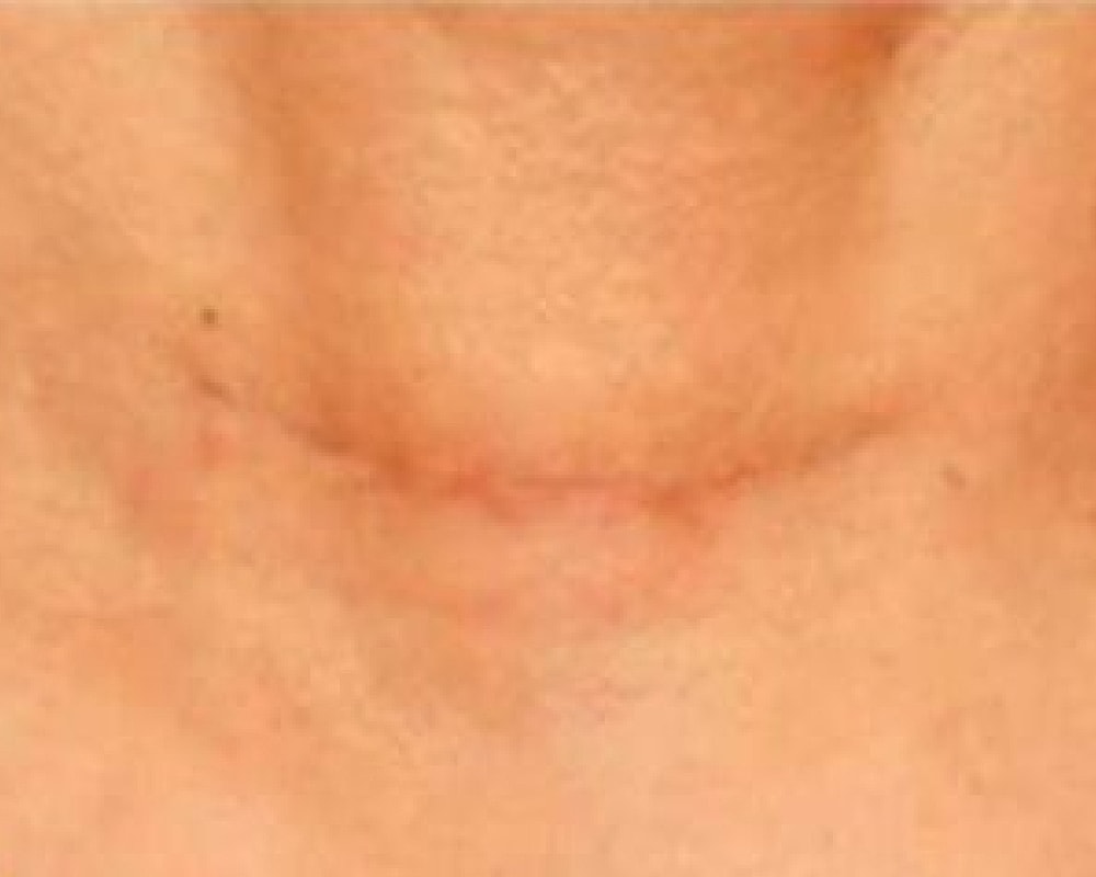 Close-up of skin with a faint scar.