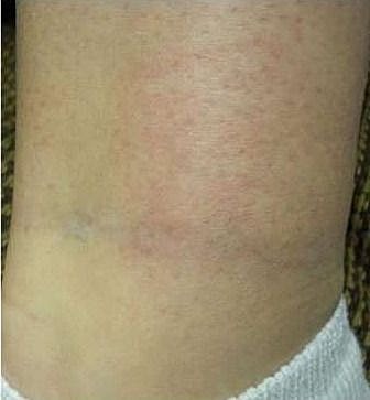 Skin with slight redness and discoloration.
