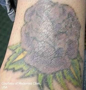 Tattoo of a flower on skin.