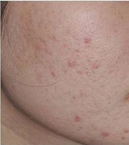 Skin with acne-like blemishes and irritation.