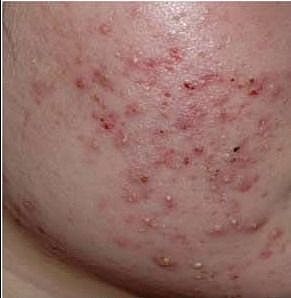 Close-up of skin with acne and blemishes.