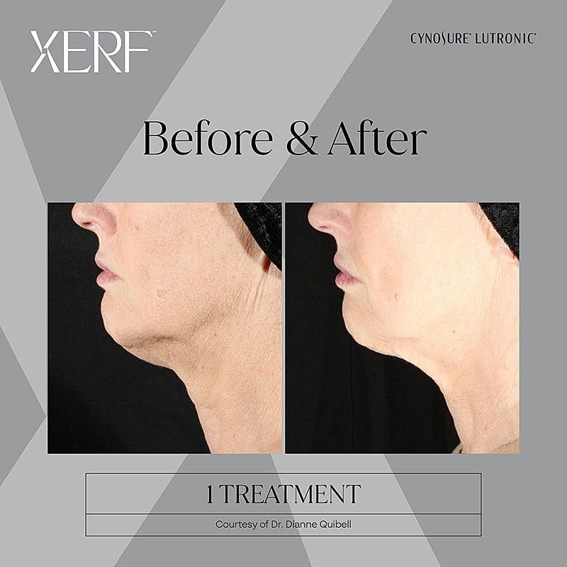 Before and after transformation from XCT treatment