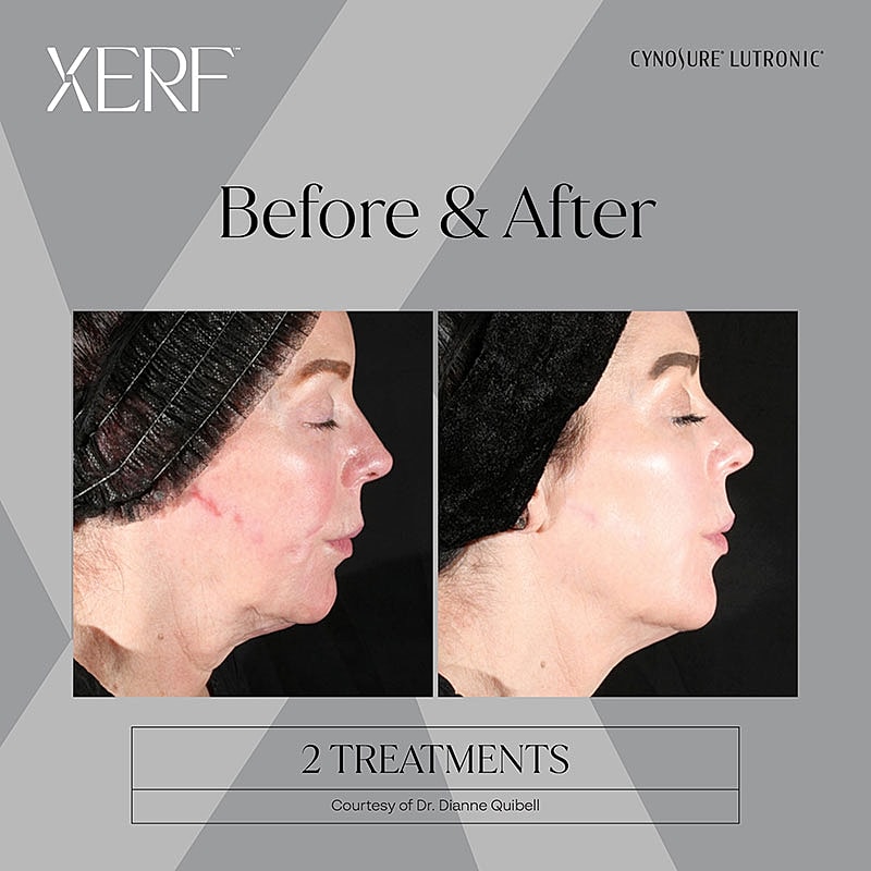 Before and after skin treatment results display