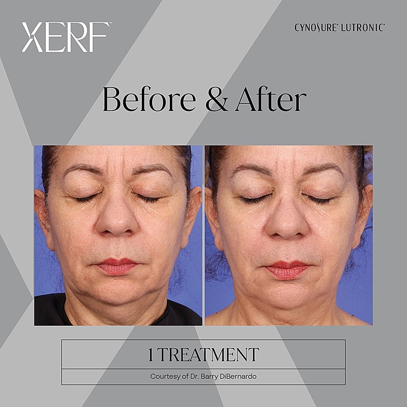 Facial treatment results: before and after comparison.