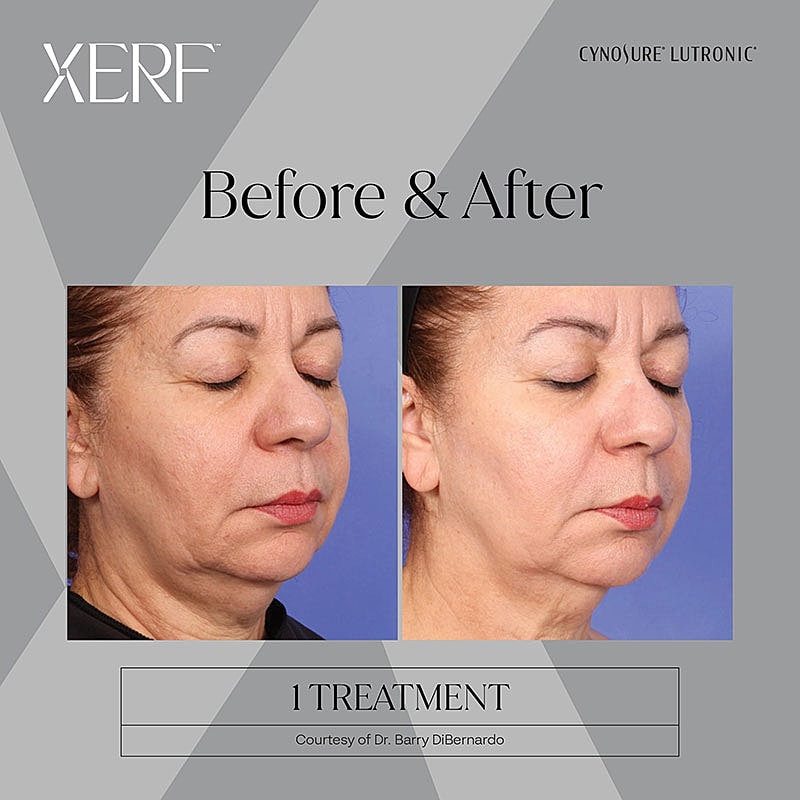 Before and after facial treatment results comparison.