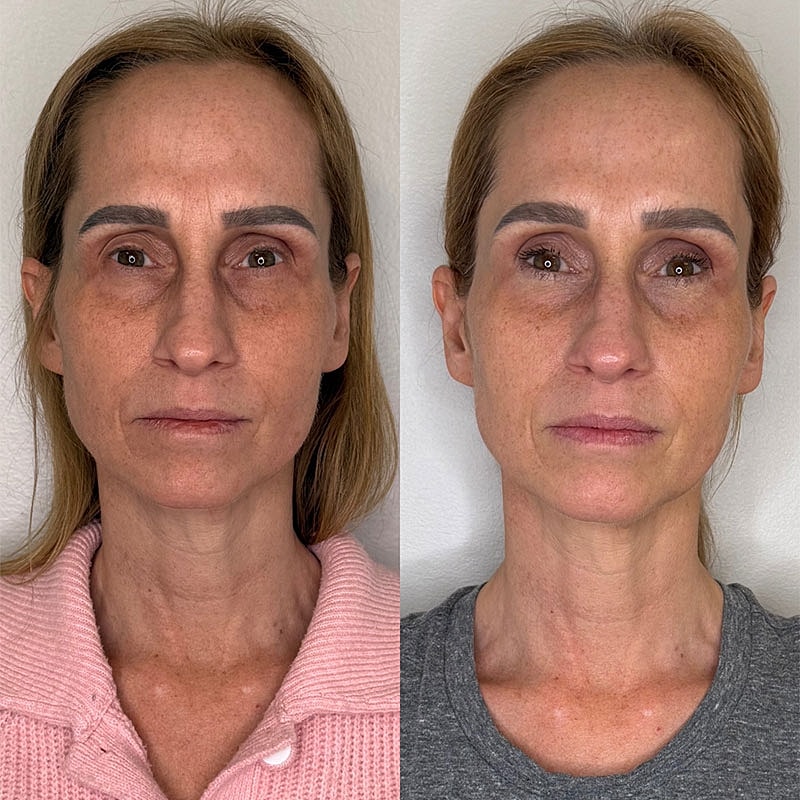 Before and after skincare treatment comparison.