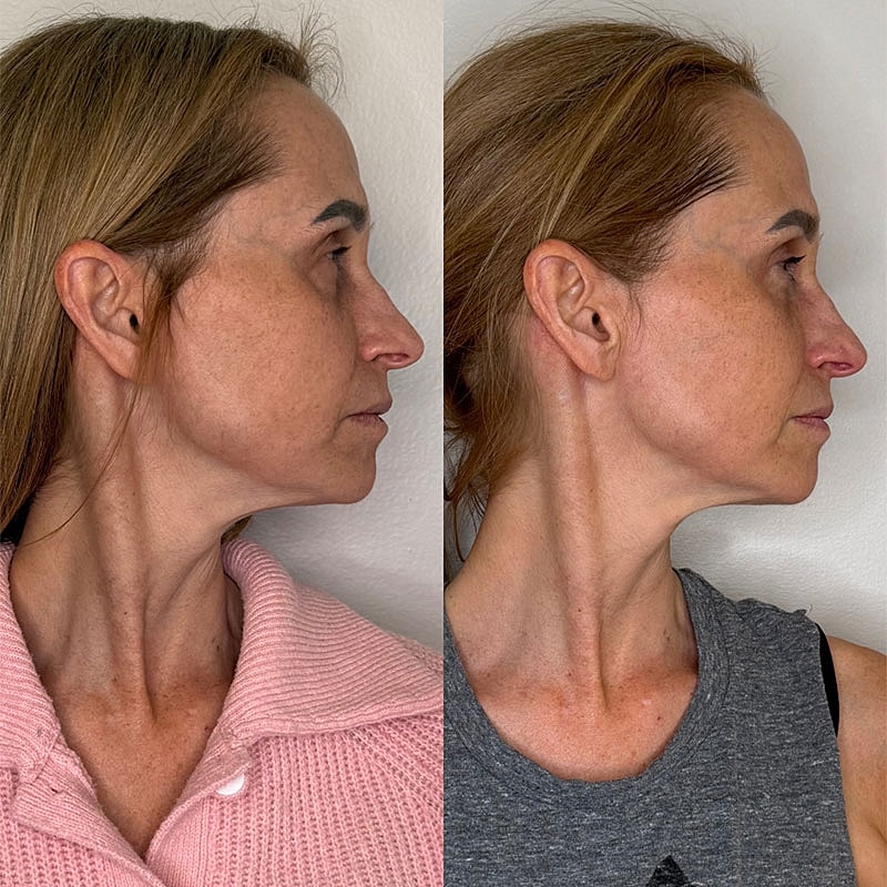 Before and after facial profile comparison.