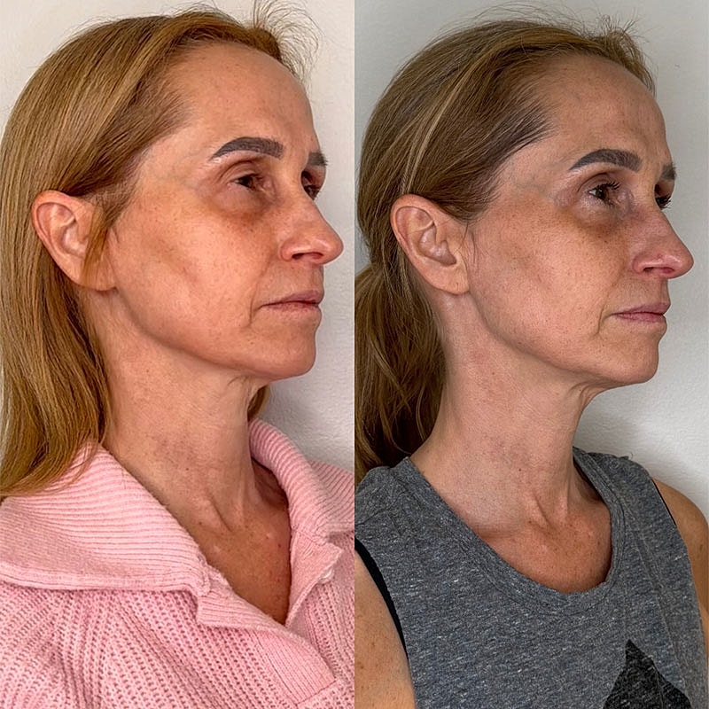 Before and after profile comparison of woman.