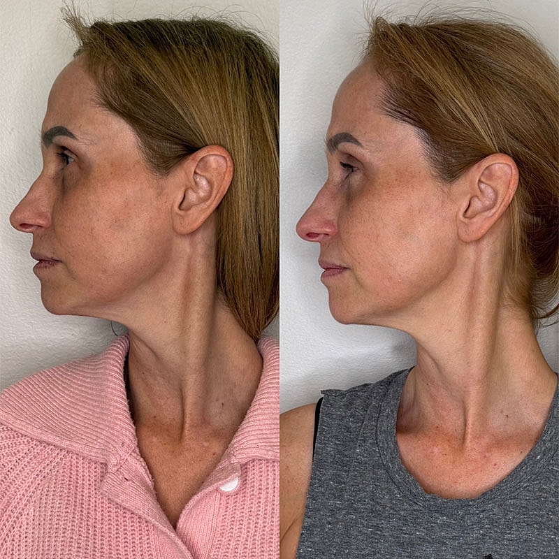 Before and after profile comparison of a woman.