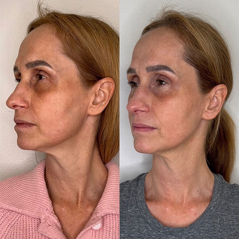 Before and after profile photos of a woman