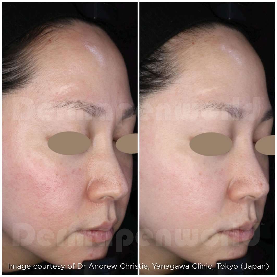 Before and after skincare treatment results.