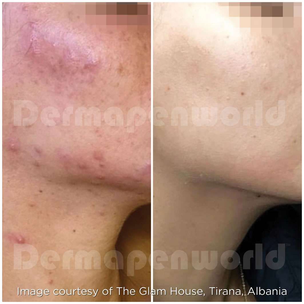 Before and after skin treatment comparison.