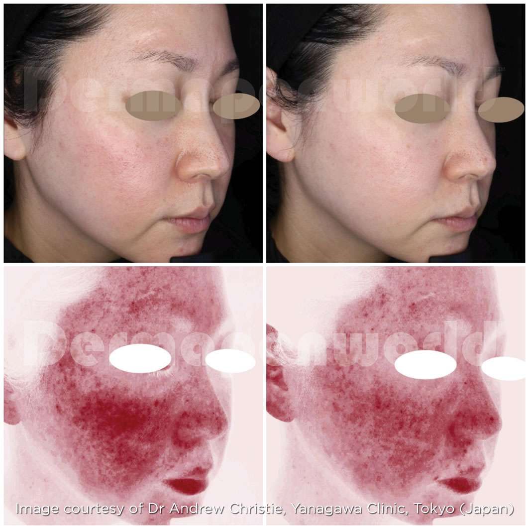 Skin analysis before and after treatment comparison.