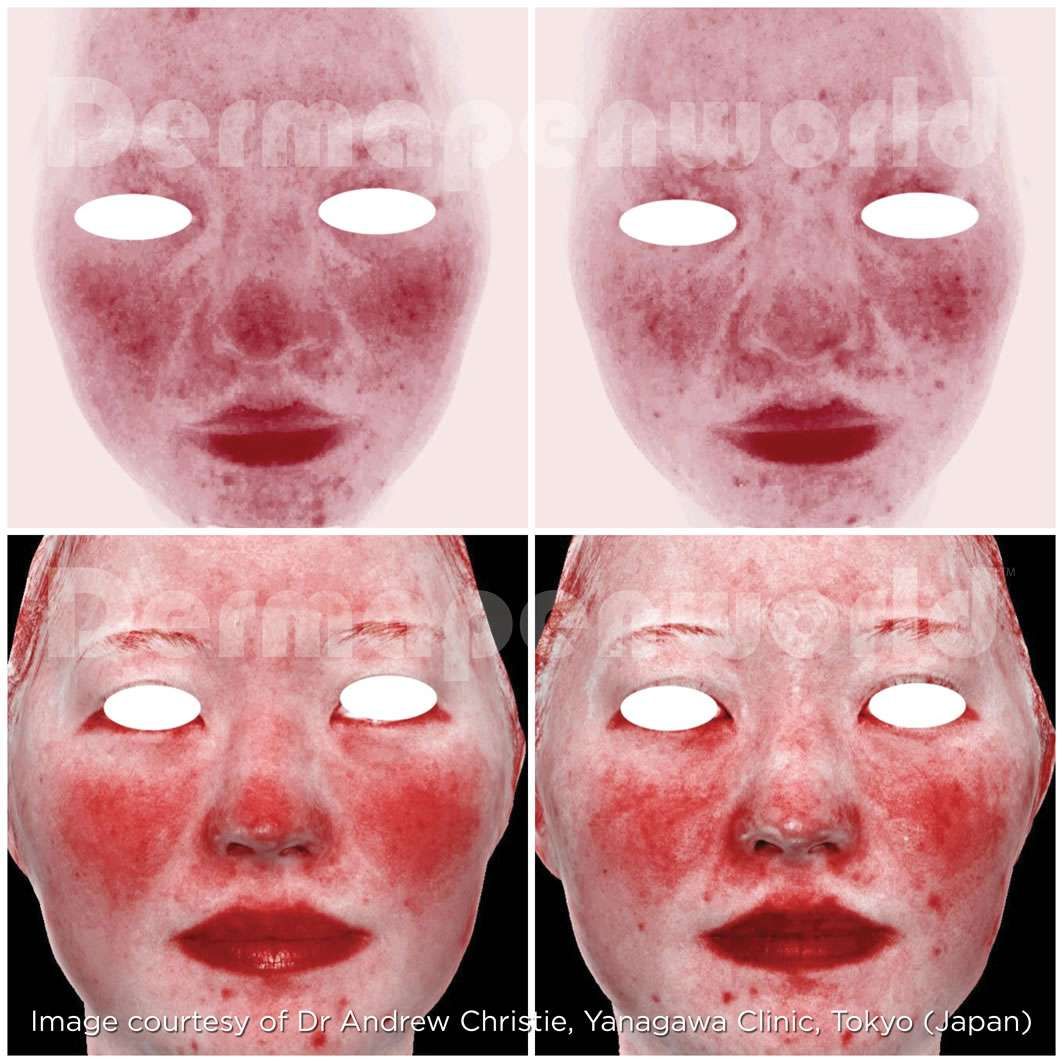 Facial skin analysis before and after treatment.