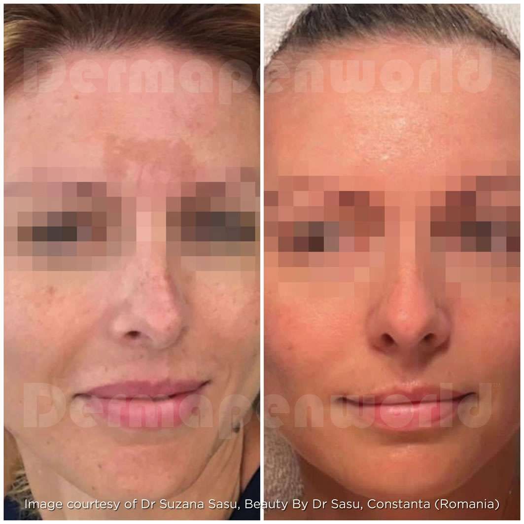Before and after skincare treatment results.
