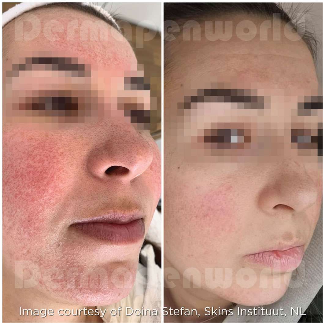 Skin treatment before and after comparison photo.